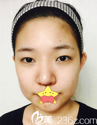 术前的我 术前的我