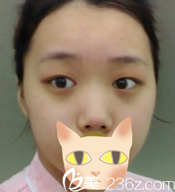 整形以前的我 整形以前的我