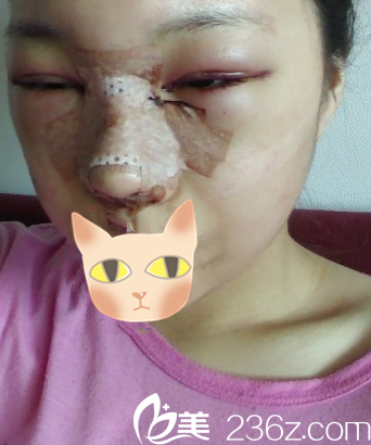 术后第二天 术后第二天