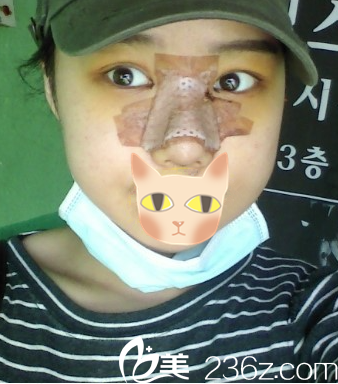 第7天,朴宰熙院长说明天可以拆线了 第7天,朴宰熙院长说明天可以拆线了