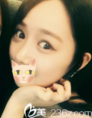 我在韩国Motive整形外科做完的效果 我在韩国Motive整形外科做完的效果