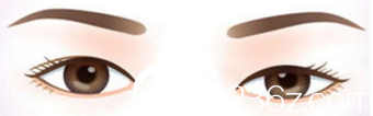 双眼皮效果