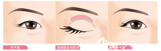 双眼皮手术效果