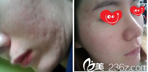 祛痘印对比图 祛痘印对比图