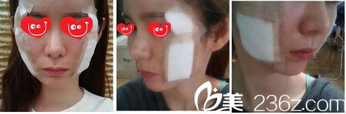 痘坑治疗 痘坑治疗