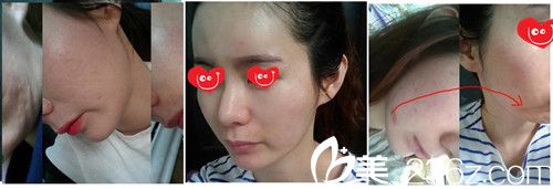 祛痘第二天 祛痘第二天