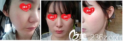 去痘坑两月效果、 去痘坑两月效果、