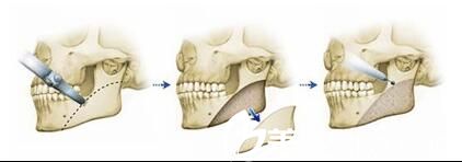 下颌角切除术方法
