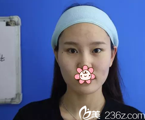 遵义韩美于建涛做全切双眼皮+开内眼角 遵义韩美于建涛做全切双眼皮+开内眼角