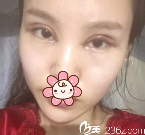 于建涛双眼皮术后3天 于建涛双眼皮术后3天