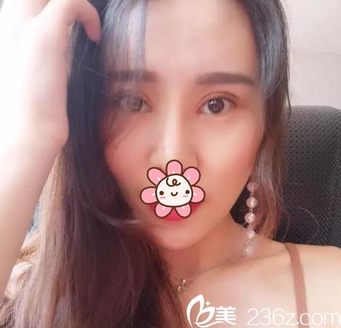 双眼皮手术后7天 双眼皮手术后7天