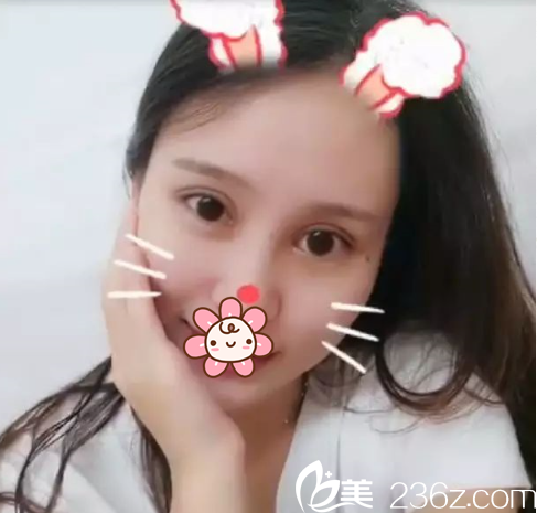 遵义双眼皮手术后15天 遵义双眼皮手术后15天