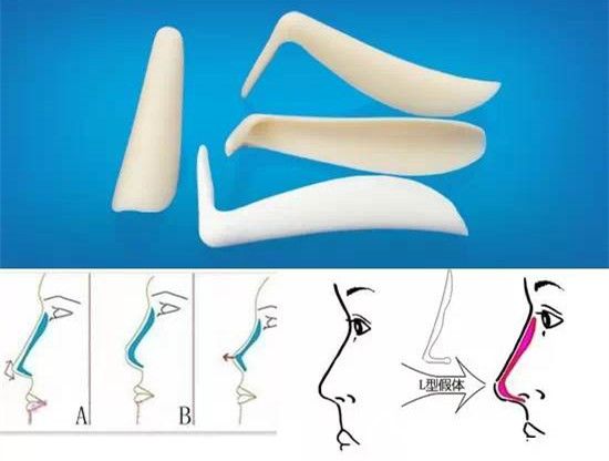 单纯L型假体隆鼻
