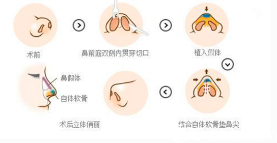 加耳软骨垫鼻尖的复合假体隆鼻