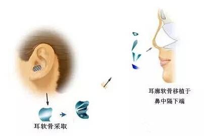 自体软骨移植为核心的鼻综合