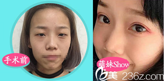 成都军建整形<!--<i data=20240703-sp></i>-->双眼皮案例