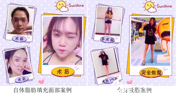 成都军建自体脂肪填充、吸脂案例 成都军建自体脂肪填充、吸脂案例