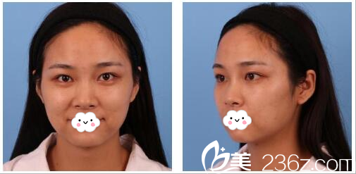 找<!--<i data=20240703-sp></i>-->做隆鼻术前照片 找<!--<i data=20240703-sp></i>-->做隆鼻术前照片