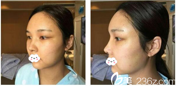 <!--<i data=20240703-sp></i>-->给我做的鼻综合隆鼻第8天自拍 <!--<i data=20240703-sp></i>-->给我做的鼻综合隆鼻第8天自拍