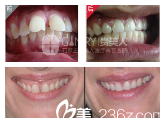 武兴肖院长正畸矫正案例 武兴肖院长正畸矫正案例