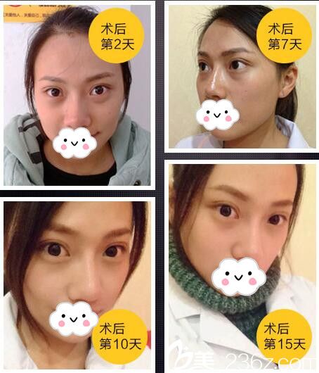 术后恢复过程中 术后恢复过程中