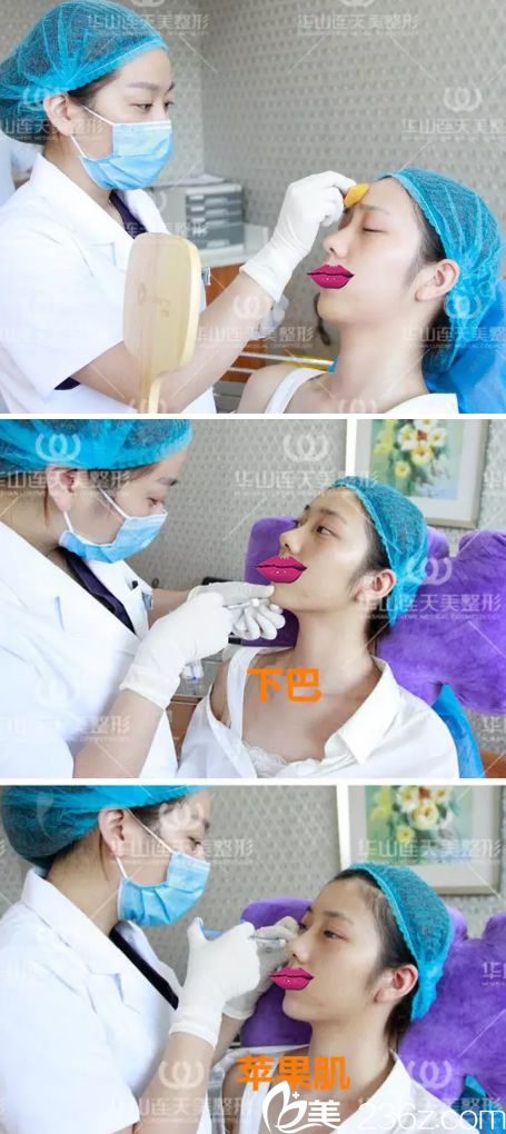 玻尿酸填充下巴和苹果肌过程