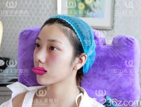 注射玻尿酸填充手术即刻效果