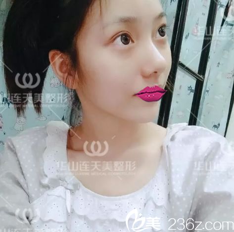 玻尿酸填充手术第1天效果