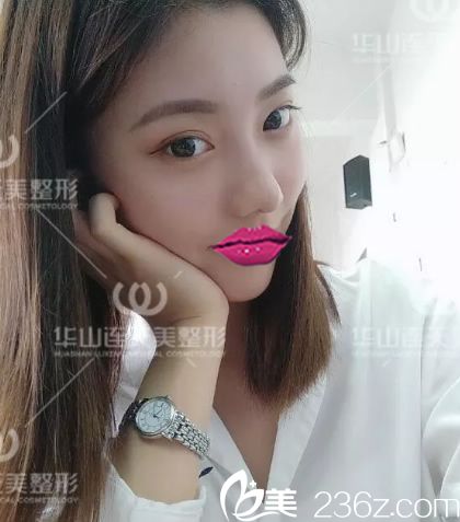 注射下巴酸第4天照片