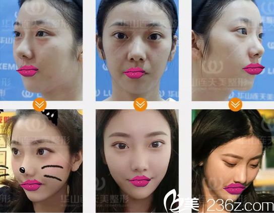 连天美李大琦玻尿酸案例