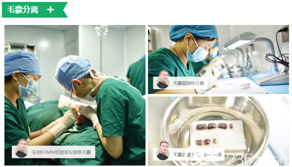 采用06mm的提取仪进行毛囊提取