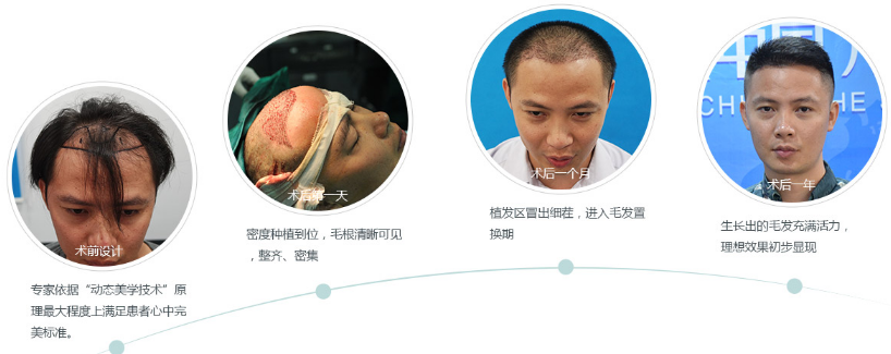 广州倍生植发医院发际线种植一年后案例效果
