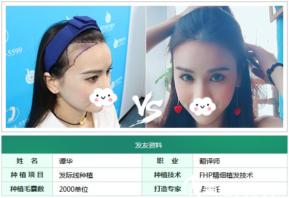 广州倍生植发医院廖骏发际线种植案例