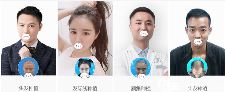 广州倍生植发案例对比图展示