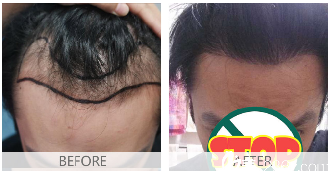 广州倍生植发医院杨晓男士发际线种植案例 广州倍生植发医院杨晓男士发际线种植案例