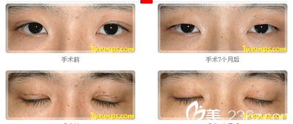 李永吉院长双眼皮恢复案例 李永吉院长双眼皮恢复案例