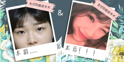 王先松全切双眼皮术前术后对比照 王先松全切双眼皮术前术后对比照