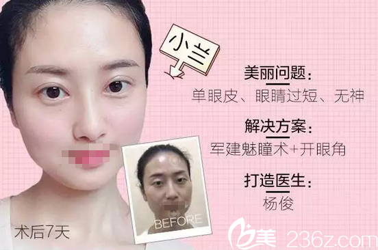 成都军建医院整形美容中心双眼皮对比照 成都军建医院整形美容中心双眼皮对比照