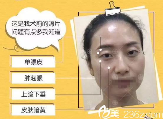 双眼皮+开眼角术前照片 双眼皮+开眼角术前照片