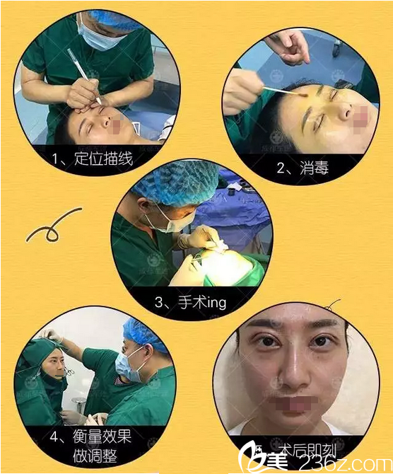 杨俊双眼皮手术过程图分享