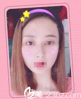 双眼皮+开眼角术后1天照片 双眼皮+开眼角术后1天照片