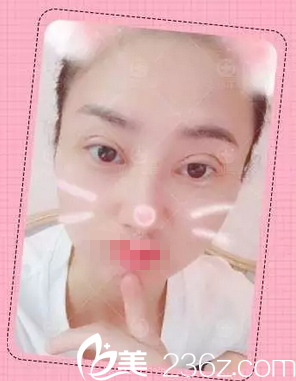 <!--<i data=20240703-sp></i>-->双眼皮术后3天恢复情况 <!--<i data=20240703-sp></i>-->双眼皮术后3天恢复情况