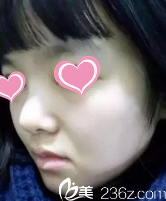 术前鼻子塌平 术前鼻子塌平