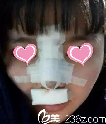 刚做完鼻综合手术的样子 刚做完鼻综合手术的样子