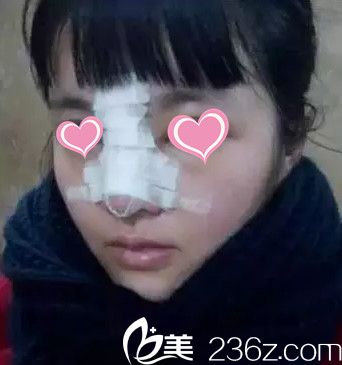 术后第3天鼻子肿胀厉害 术后第3天鼻子肿胀厉害