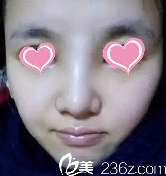 做完鼻综合手术7天拆线后的样子 做完鼻综合手术7天拆线后的样子