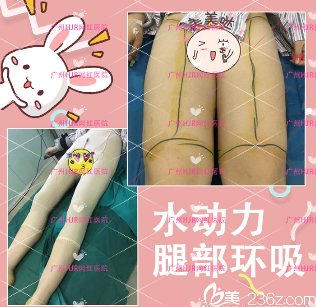 广州韩佳人整形医院大腿吸脂案例
