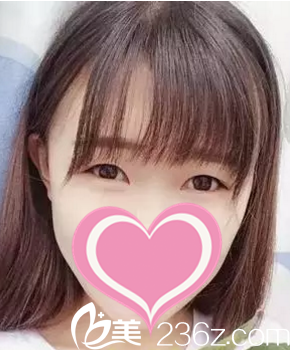 做双眼皮术前照 做双眼皮术前照