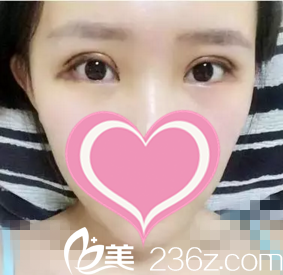 术后第五天开始消肿 术后第五天开始消肿