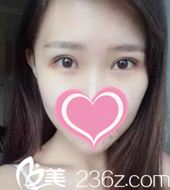 术后一周拆线 术后一周拆线